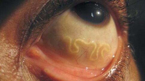 parasites in human eyes mắt