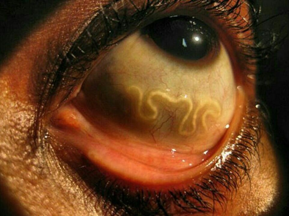 parasites in human eye