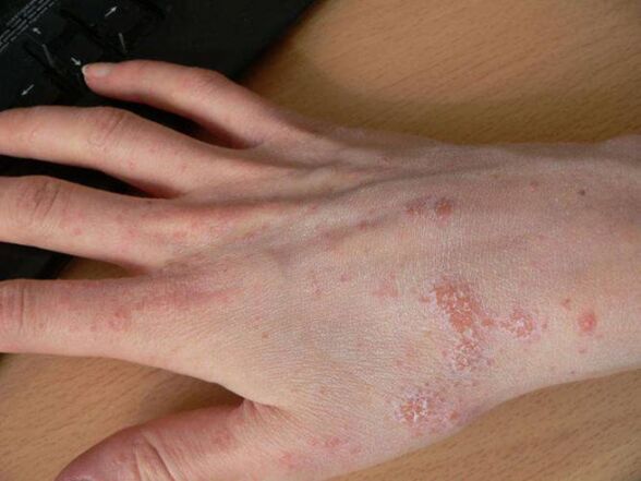 scabies on hand with a mite under the skin
